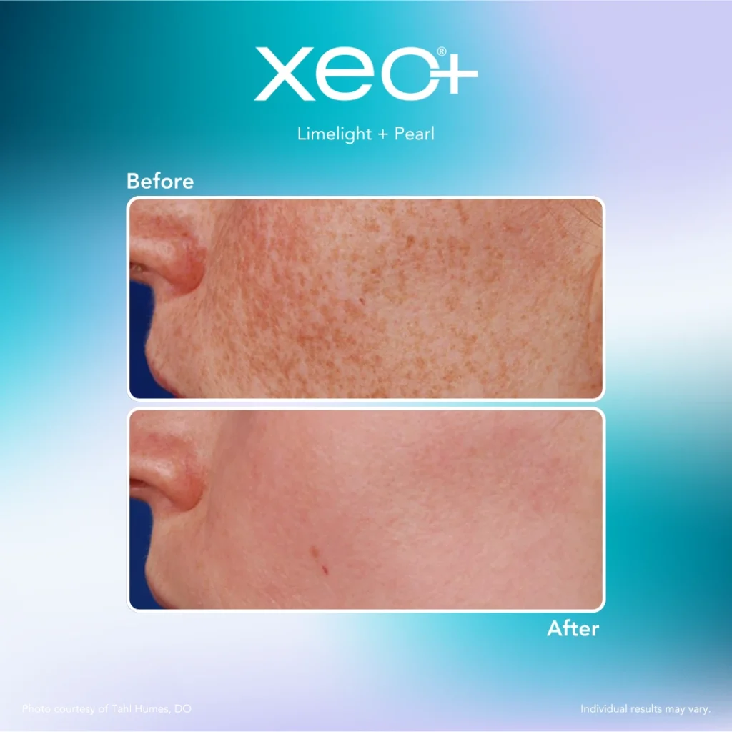 pigmentation removal in Richmond, KY