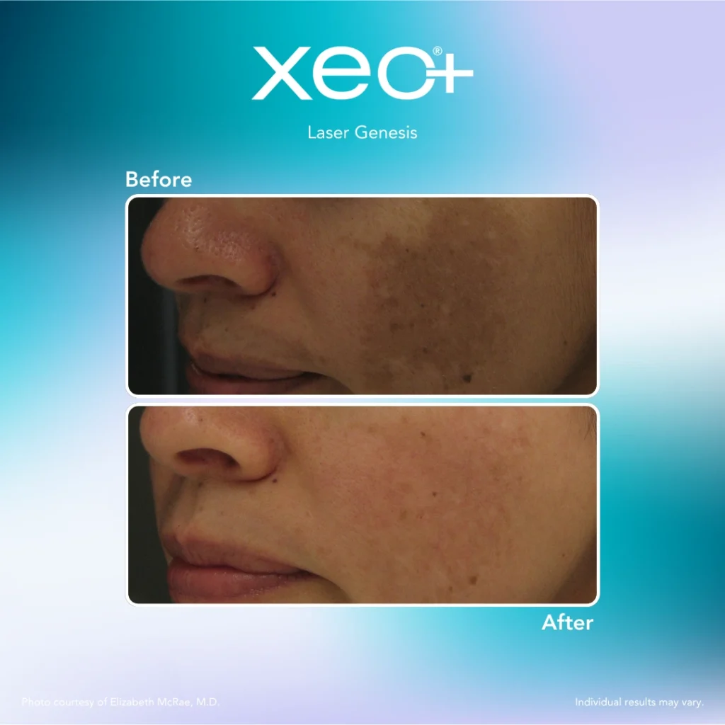 Laser Genesis (Hollywood Laser Facial) in Richmond, KY