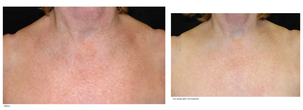 skin discoloration treatments