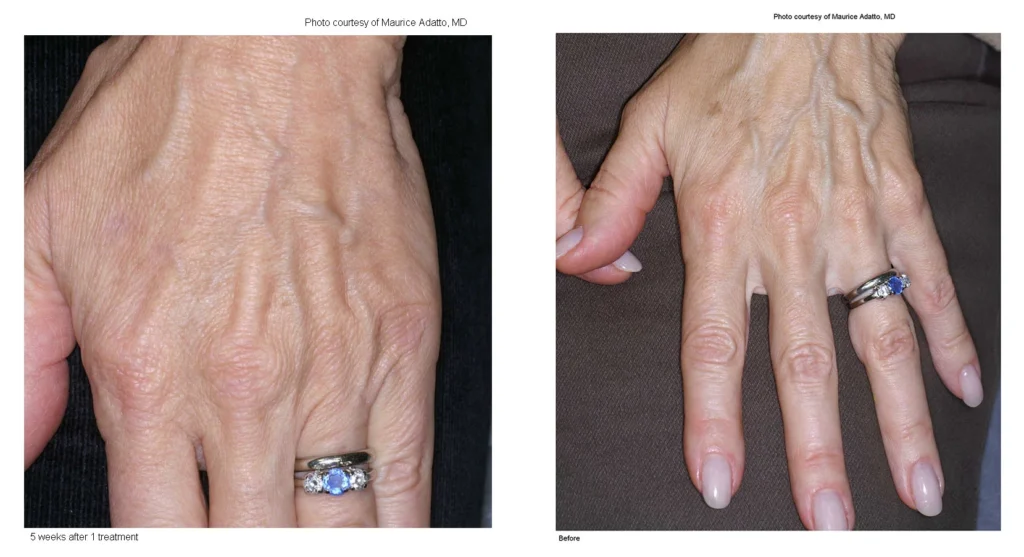 Limelight IPL in Richmond, KY