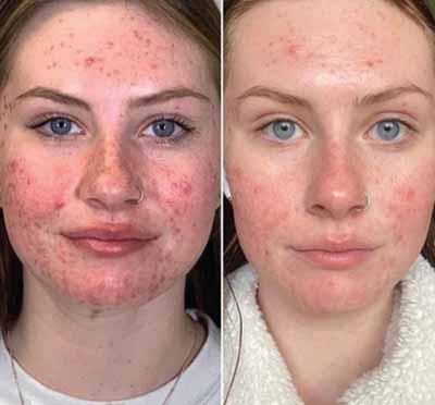 B_A_sforWebsite-V02-01_390x - The Skin Suite Chemical Peels in Richmond, KY