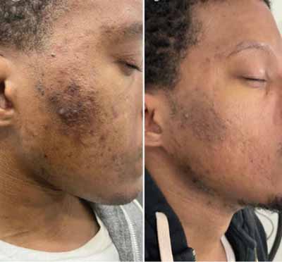 B_A_sforWebsite-V02-02_390x - The Skin Suite Chemical Peels in Richmond, KY