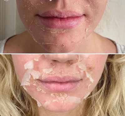 B_A_sforWebsite-V02-03_390x - The Skin Suite Chemical Peels in Richmond, KY
