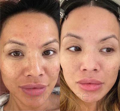B_A_sforWebsite-V02-04_390x - The Skin Suite Chemical Peels in Richmond, KY