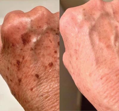 B_A_sforWebsite-V02-05_390x - The Skin Suite Chemical Peels in Richmond, KY