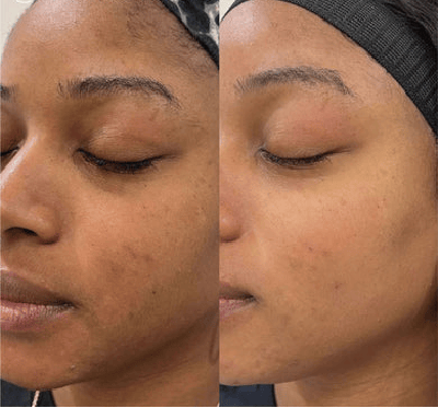 B_A_sforWebsite-V02-06_390x - The Skin Suite Chemical Peels in Richmond, KY