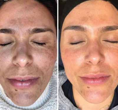 B_A_sforWebsite-V02-07_390x - The Skin Suite Chemical Peels in Richmond, KY