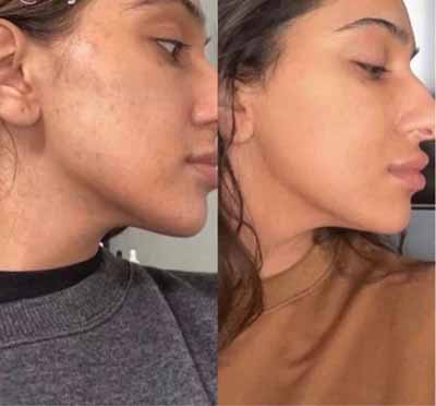 B_A_sforWebsite-V02-08_390x - The Skin Suite Chemical Peels in Richmond, KY